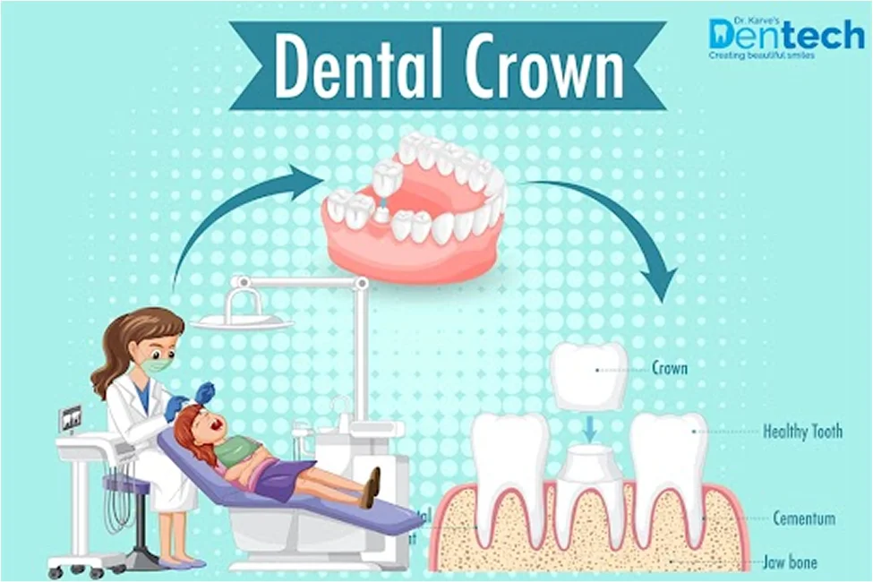 Dental Crown Cost in Mumbai India
